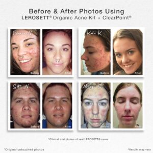 Organic-Acne-Kit+ClearPoint