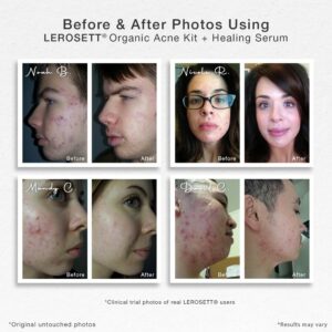 Organic-Acne-Kit+Healing