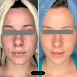 glycolic acid